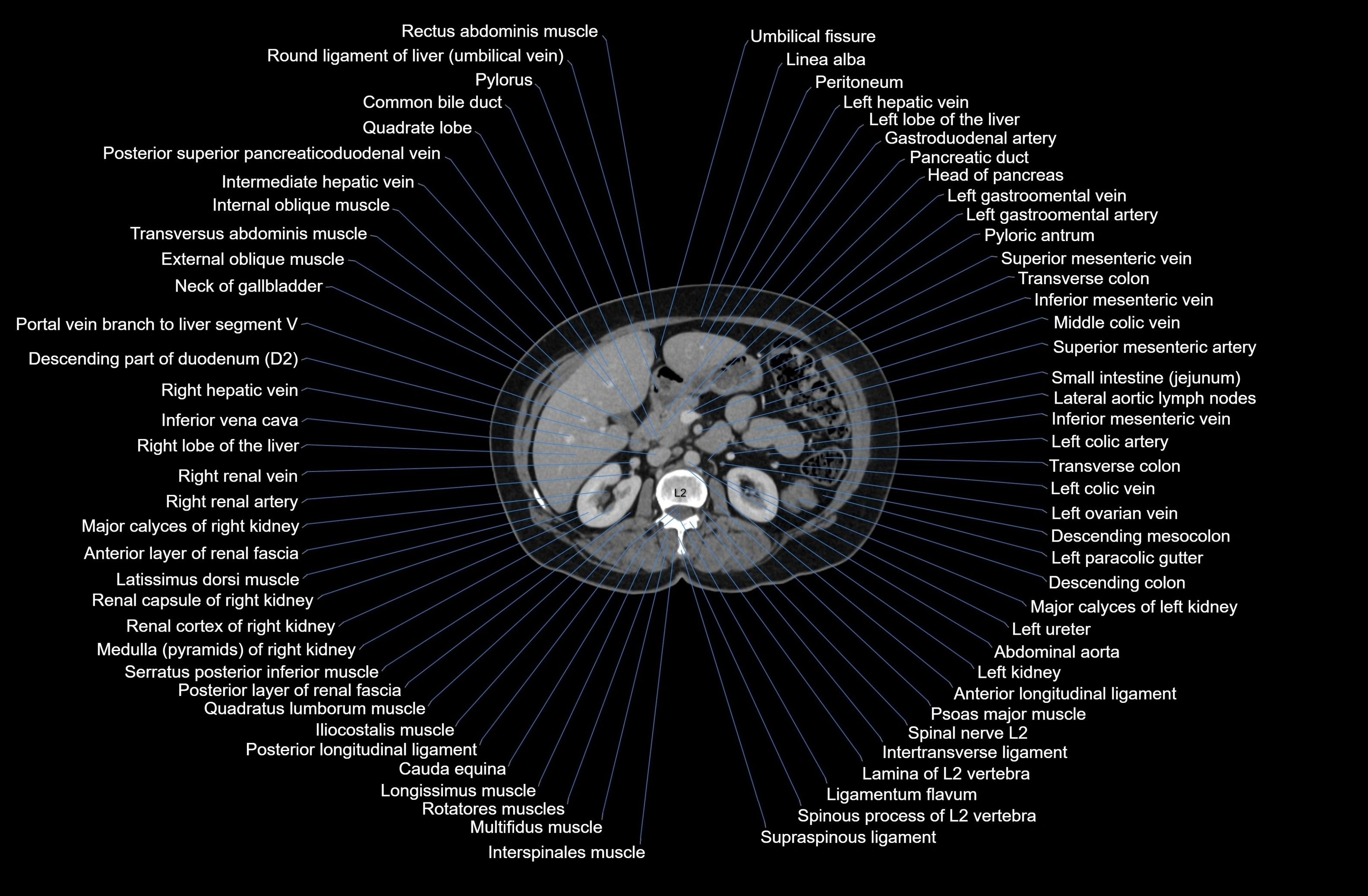 CT Abdomen axial cross sectional anatomy labelled radiology image-00035.webp
